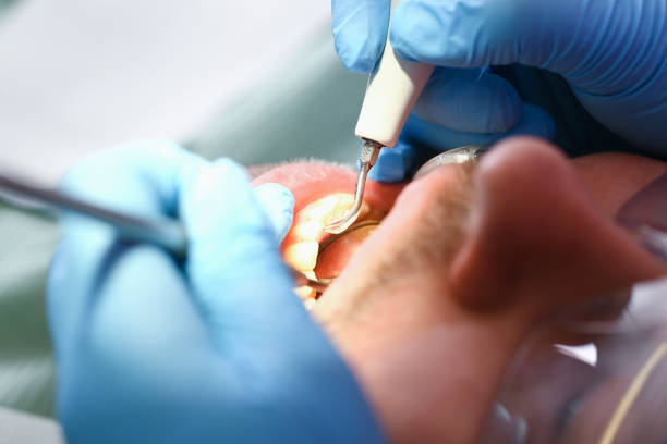 Best Emergency Tooth Extraction  in Mount Hermon, CA