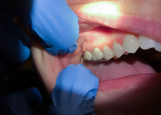 Best Emergency Gum Pain Relief  in Mount Hermon, CA